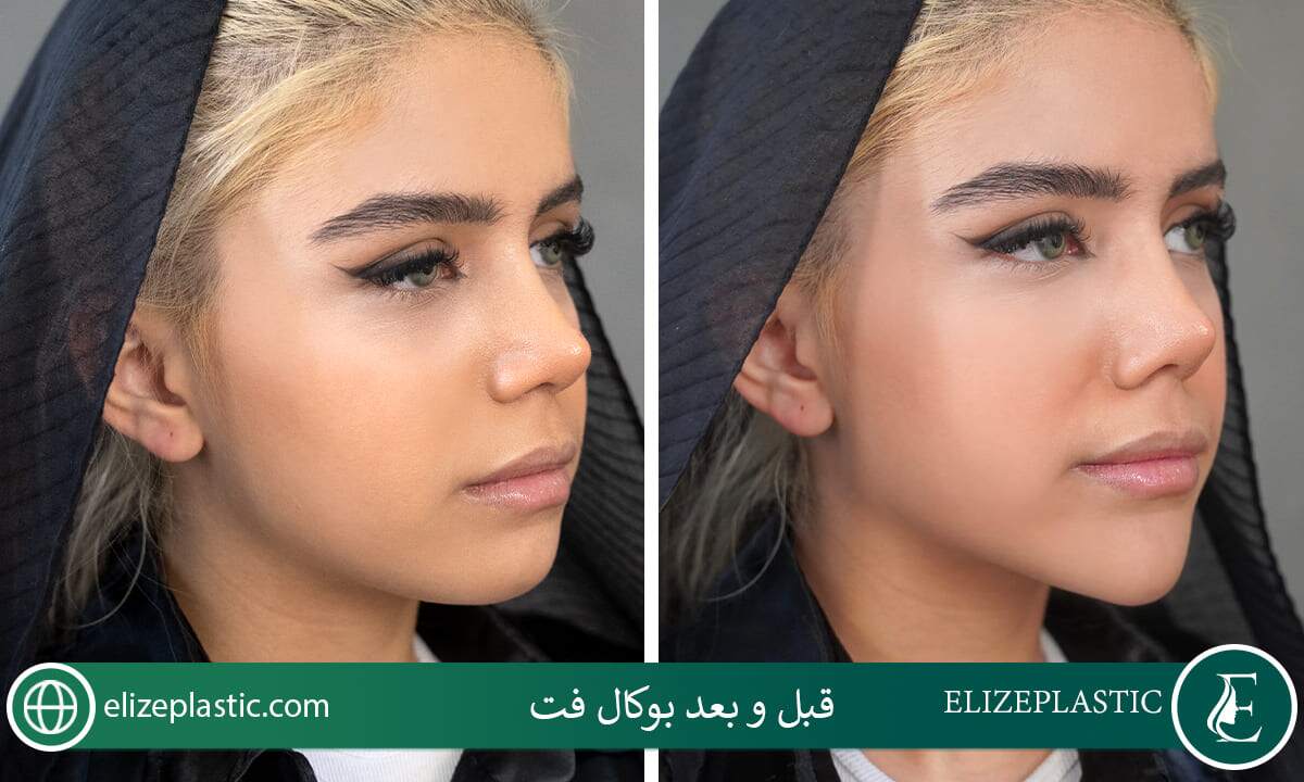 قبل و بعد بوکال فت